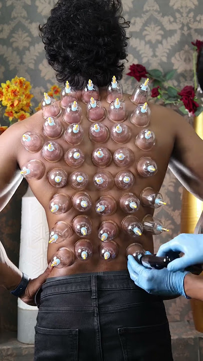 அருவியாய் கொட்டும் குடுவை சிகிச்சை அருணின் முதுகில் இருந்து #cupping #cuppingtherapy #chennai #face