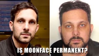 Is Moonface Permanent? Does it affect you for the rest of your life?