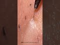 埋没毛抜きました