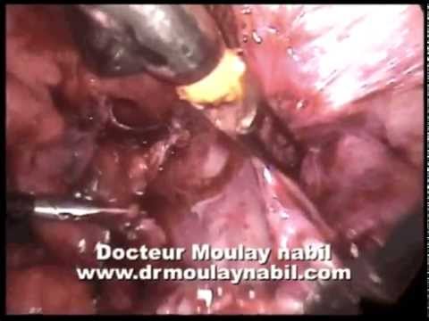 Laparoscopic hysterectomy on frozen pelvis - YouTube frozen pelvis diagram 