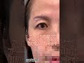 眉下リフトでこの変化‼️#眉下リフト #眉下切開 #整形