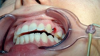 Как происходит имплантация зубов(Если у вас назрела необходимость вставить зубы, обязательно посмотрите этот короткий видеоролик. В нем..., 2016-01-10T11:08:41.000Z)