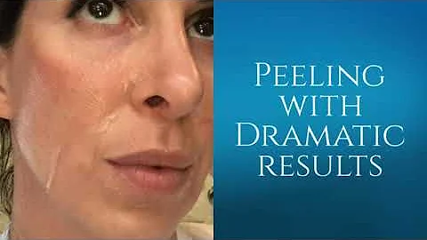 #ZO 3 Step Peel For Wrinkles and Sun Damage