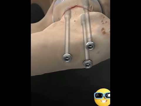 تثبيت كسر عنق الفخذ باستخدام المسامير المجوفة       