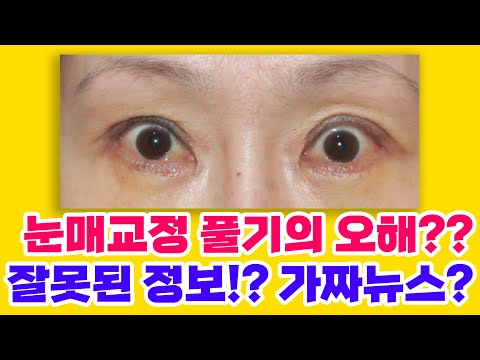 성형상담소 💌 I 눈매교정 풀기의 오해?? 잘못된 정보!? 가짜뉴스?