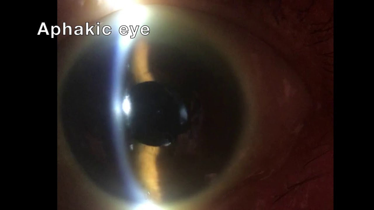 Aphakic eye YouTube