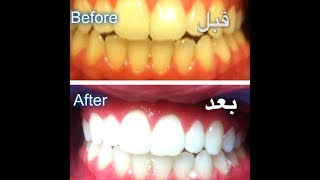 وصفة رهيبة و فعالة لتبيض الاسنان وعلاج اللثة وتعطير رائحة الفم من اول استعمال