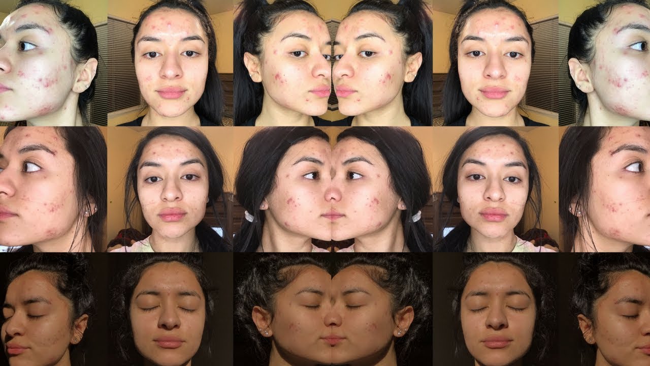 how i cleared my cystic acne in a month - YouTube