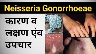 Gonorrhea Neiseriea कारण लक्षण उपचार