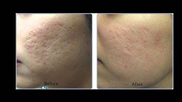 Pixel Laser at Krauss Dermatology