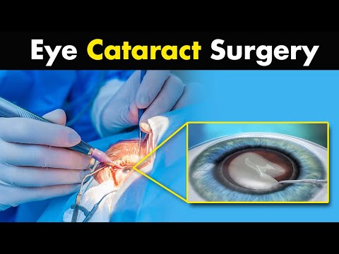 What Happens In Cataract Surgery? | Intraocular Lens (IOL) Implant  - 3D Animation