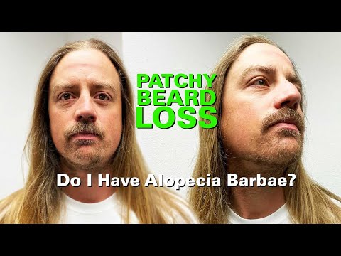 Video: Alopecia Barbae: Vzroki, Simptomi In Zdravljenje