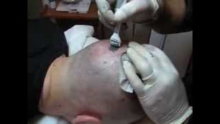 Micropigmentare scalp clinica SlimArt roller 56 ace Oron57
