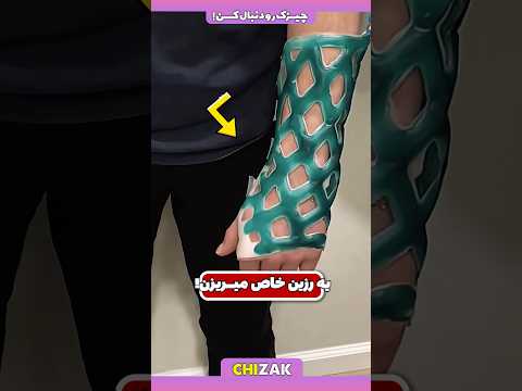 جایگزین گچ های پزشکی استفاده از رزین در تجهیزات پزشکی