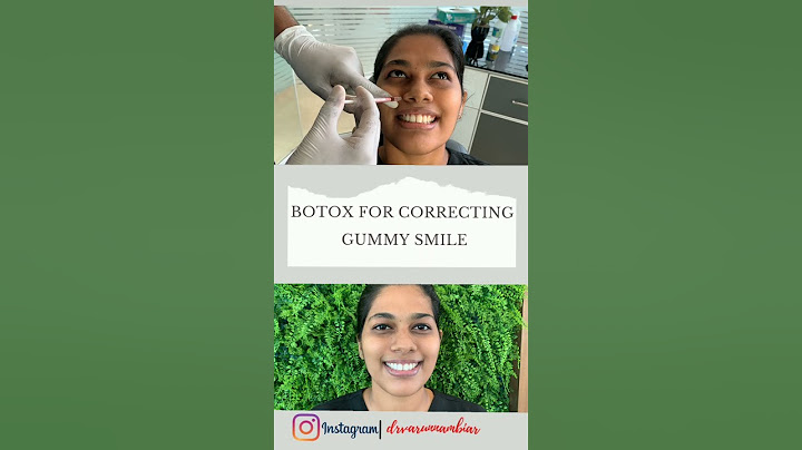 #shorts #youtubeshorts BOTOX for Gummy Smile Correction | Dr Varun Nambiar |Celebrity Facial Surgeon