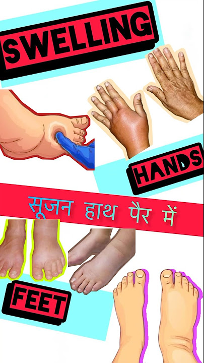 (Swelling in feet and hands)#medicine #knowledge #pharmacist #youtube #youtubeshorts #new #ytshorts