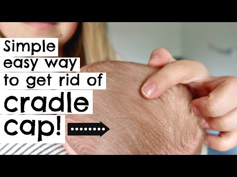 HOW TO GET RID OF CRADLE CAP IN ONE TRY! || NEWBORN
