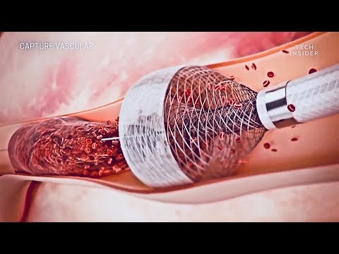 Novo dispositivo remove coágulos de sangue com muito mais eficiência - MegaVac