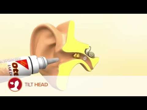 Video: Ar otex gali pažeisti ausį?