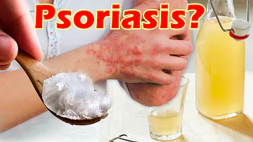 ¿Ayuda el agua de limón a la psoriasis?