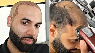 I SHAVED MY HEAD BALD 4 YEARS POST HAIR TRANSPLANT
