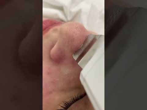 Removing Blackheads From