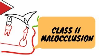Class II malocclusion | FEATURES |