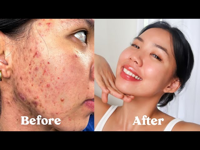 (ENG SUB) HOW I GOT RID OF MY ACNE, SCARS, TEXTURE & HYPERPIGMENTATION  *not sponsored* class=