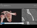 Dicom to 3d conversion using d2p for 3d printing and vsp