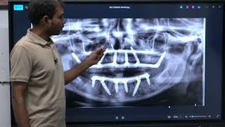 Unblind Pterygoid Implant series - part 2