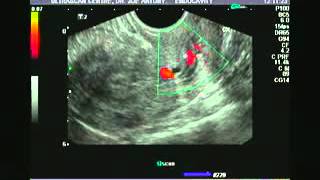 Ultrasound and Color Doppler videos_ Pedunculated cervical polyp- Ultrasound videos_.FLV