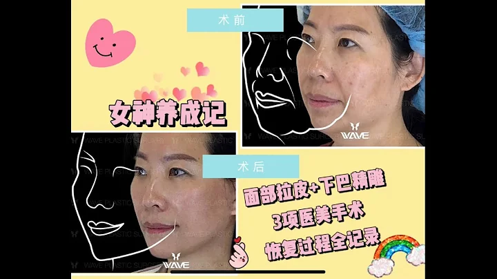 【真實案例】50歲做完拉皮手術的真實感覺是怎樣的呢? 當然是後悔! 後悔沒有早點做！ - 天天要聞