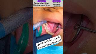 كيفية علاج تسوس الأسنان | Dental Caries Removal #viral #reels #shorts #dr_eslam_nabil