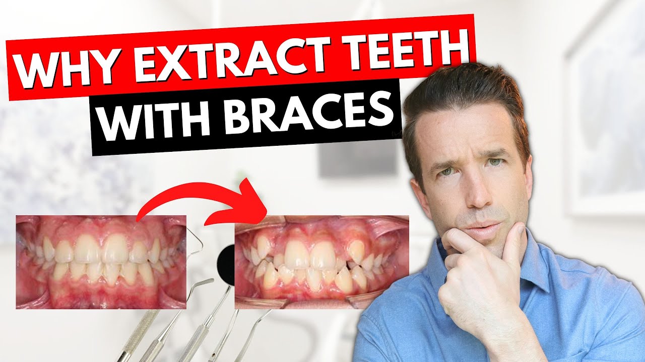 Take our 4 Teeth For Braces?! Dr. Nate YouTube