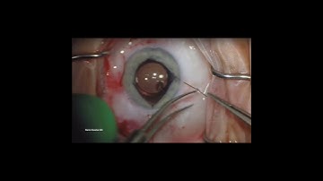 Technique Series: Iris Hook via the Main Incision - Rami Shasha MD