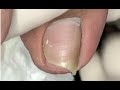 Slightly bend nail