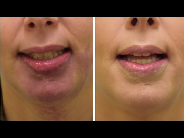 Dallas Lip Reduction/Correction for Hemangioma