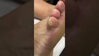 Experience Toe-Tal Relief With Down Under Foot Care! Watch Now! #Podiatrist #Cornremoval #Toecare