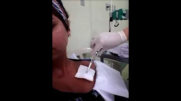 Como é feita a limpeza de cateter?