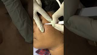 Best Comedones Extraction Treatment | Viral #shorts