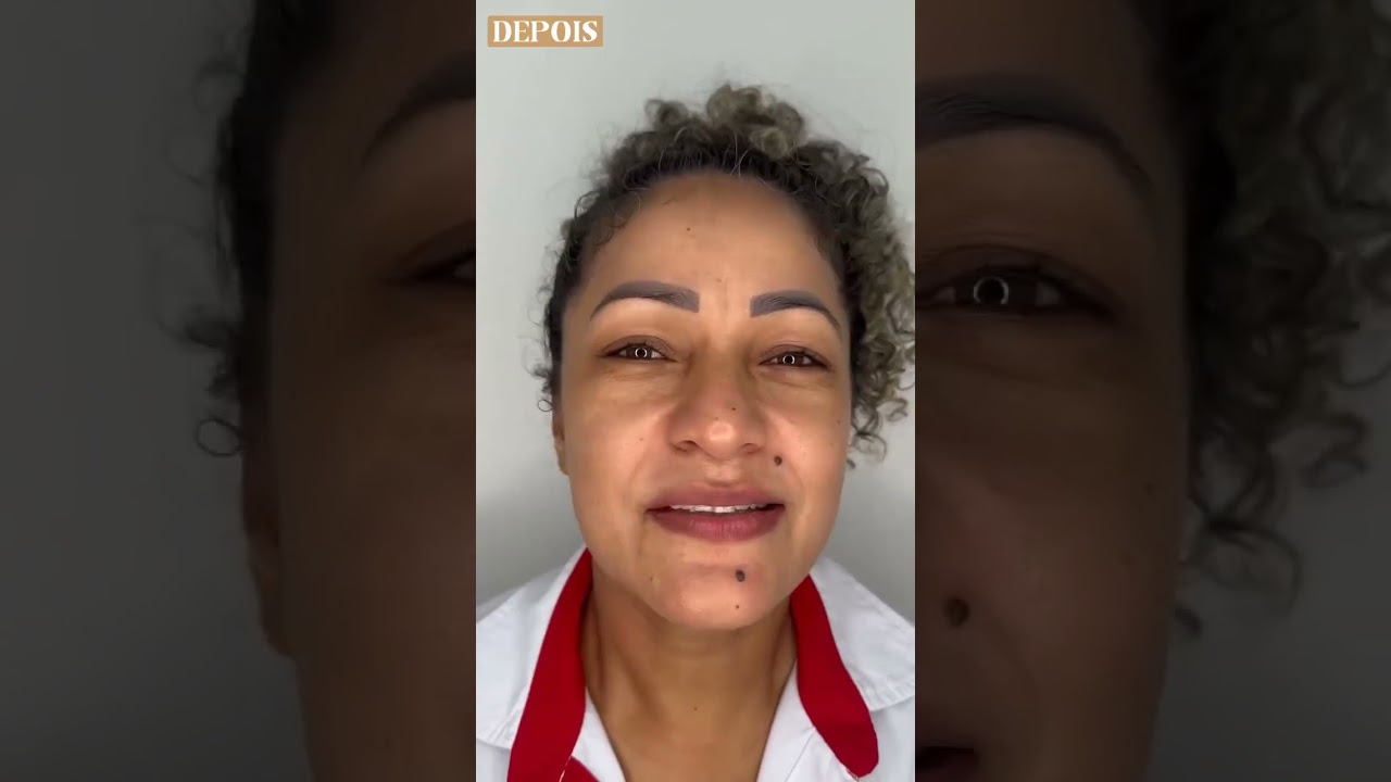 Antes e Depois | Dra. Andrea Mariotto