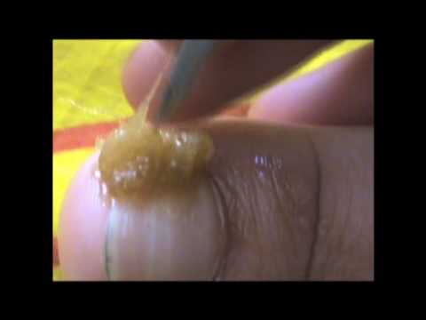 Se exfolia la uña sobre el pulgar de la mano que hacer como curar