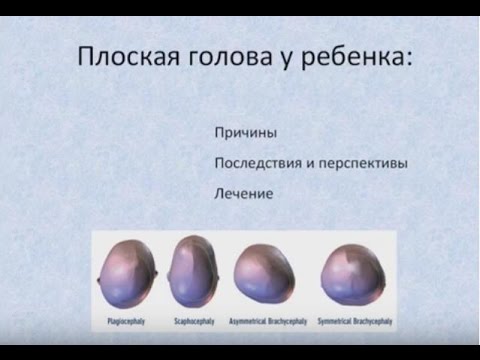 Плоская голова у ребенка: плагиоцефалия