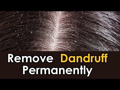how-to-remove-dandruff-permanently-|-how-to-remove-dandruff-at-home-naturally-in-one-day
