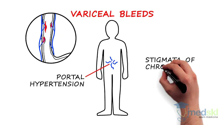 Gastroenterology - Upper GI Bleeding: By John Kargbo M.D. - DayDayNews