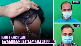 Hair Transplant Stage 1 Result & Stage 2 Planing | Dr. Jayanta Bain Plastic & Cosmetic Surgeon
