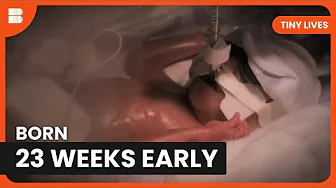 23 Week Premature Baby Charlie Fights for Life in NICU