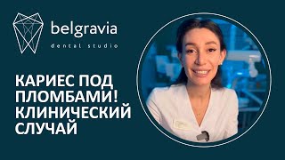 👩‍⚕️  Кариес под пломбами! Клинический случай Belgravia Dental Studio