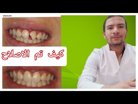 فيديو: كيفية علاج الأسنان المكسورة (بالصور)