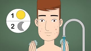 How to Get Rid of Acne (Teen Boys)